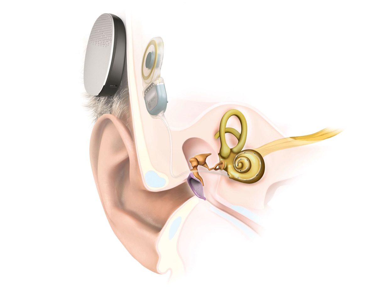 Schematische Darstellung eines Cochlea-Implantats (CI) mit Audioprozessor hinter dem Ohr und Elektrode in der Hörschnecke
